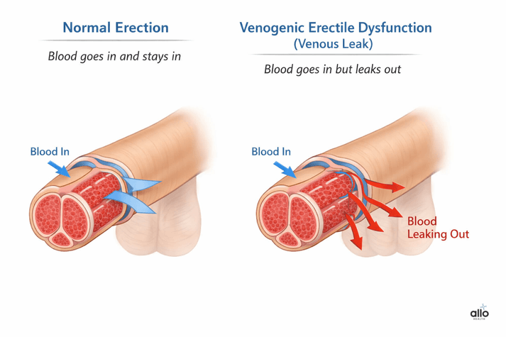 Comparison diagram showing a normal erection where blood stays trapped versus venogenic erectile dysfunction where blood leaks out through penile veins