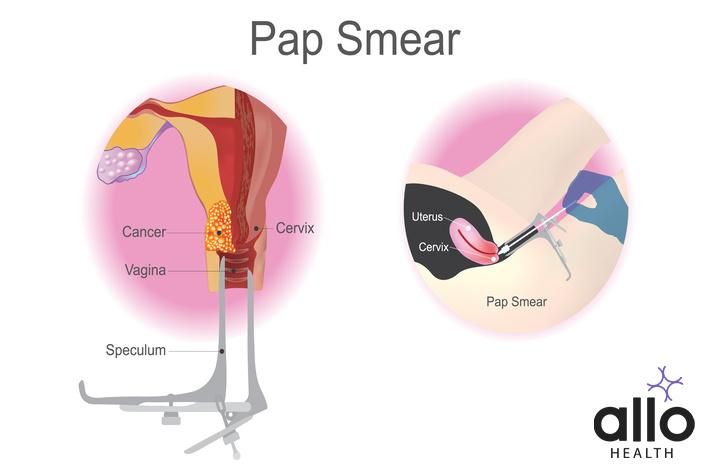 How Many Times A Year Should You Get Pap Smear Tests?
Can You Have Intercourse After a Pap Smear?