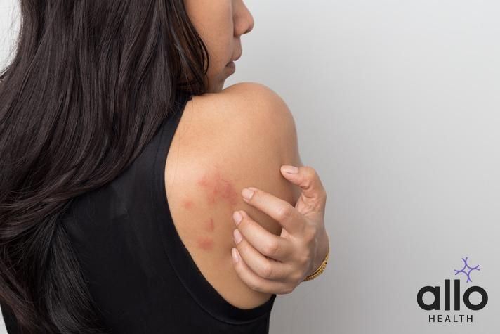 woman showing her skin itching behind , with allergy rash urticaria symptoms. eczema meaning in hindi, How Is HIV Diagnosed?