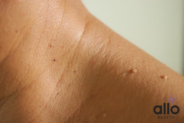 warts meaning in hindi, Physical Changes With Aging