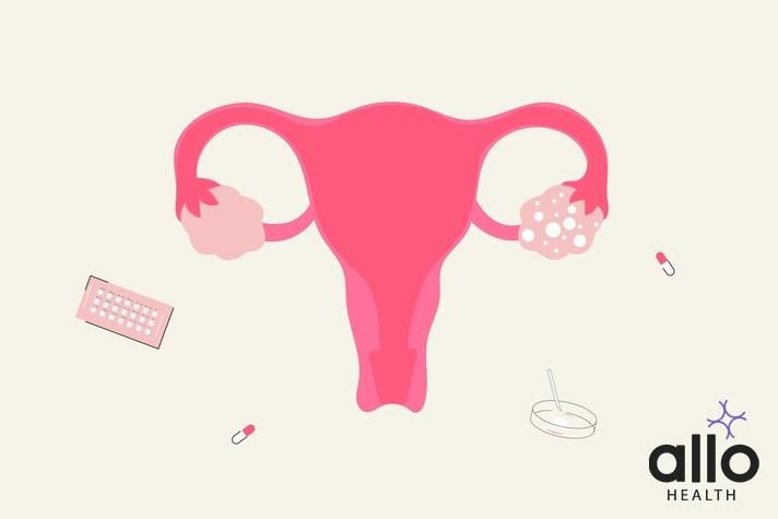 Polycystic Ovary Syndrome, Bacterial Vaginosis (BV) Effective Treatment Options