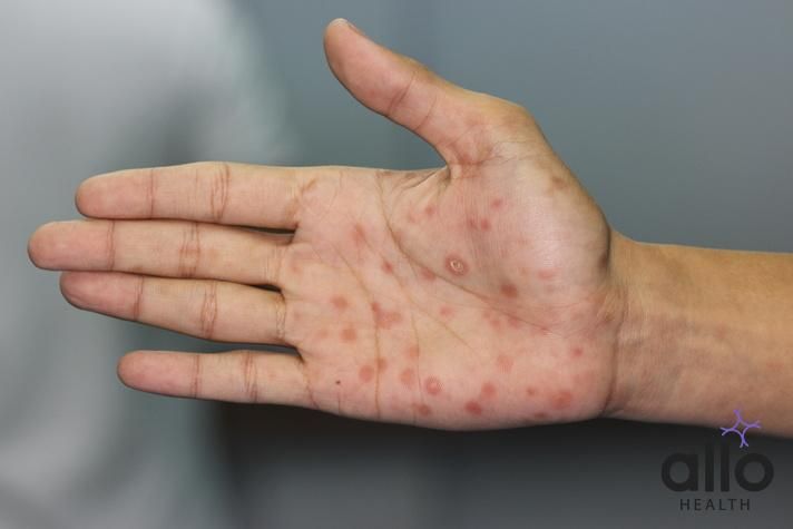 Managing Syphilis: Coping and Psychological Support