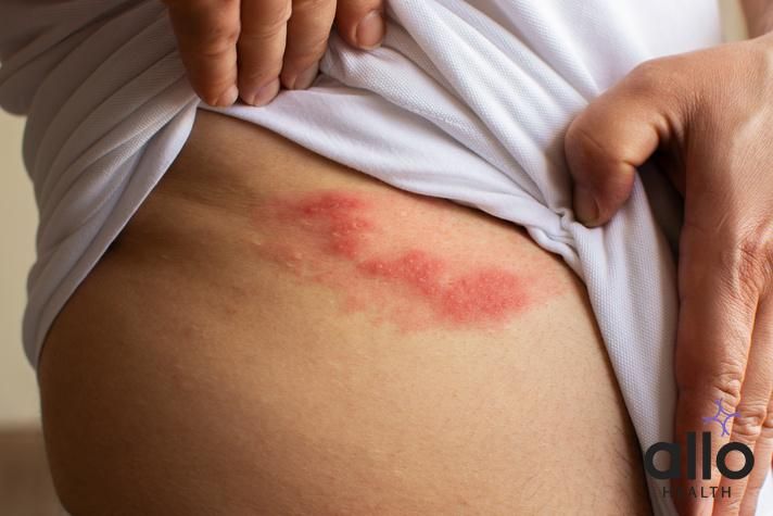What Are The Symptoms And Complications Of Herpes?