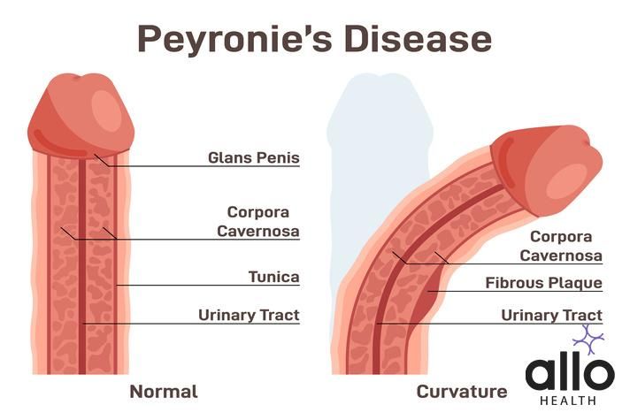 What Is Peyronies Disease?
Peyronie&#x27;s disease. Fibrous scar tissue developing under the skin of the penis and causing a curve. Male organ&#x27; incorrect form. Flat vector illustration