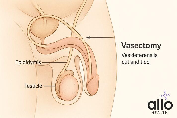 “Medical diagram showing how vasectomy is performed by cutting and tying the vas deferens, clarifying that it does not cause erectile dysfunction after vasectomy.”