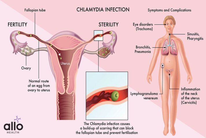 Types of Chlamydia Painful Bumps From Chlamydia