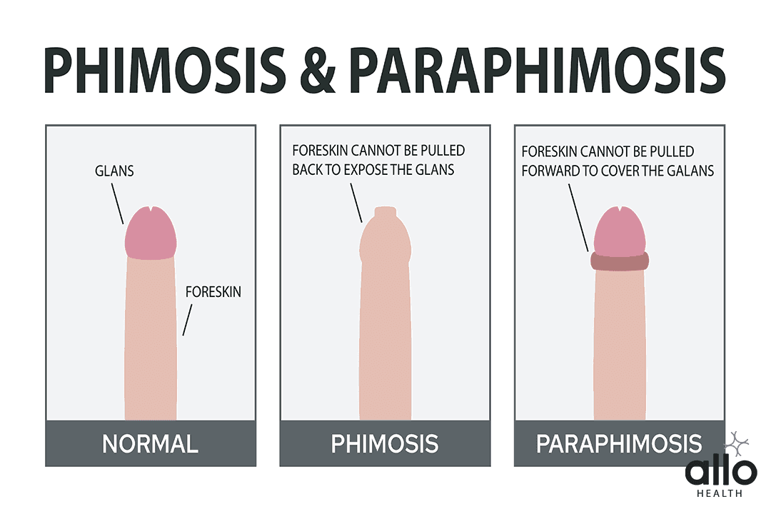 Identifying Phimosis and Premature Ejaculation Phimosis
