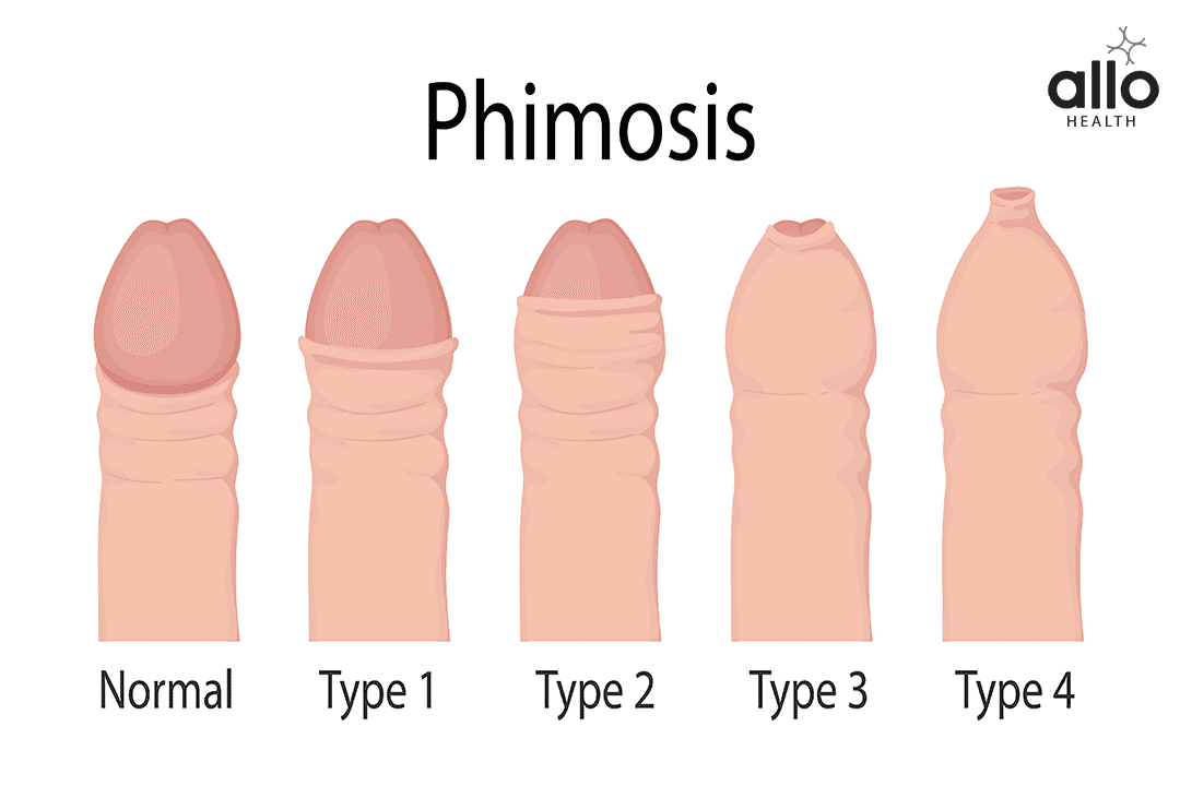 Diagnosis of phimosis Phimosis Treatment