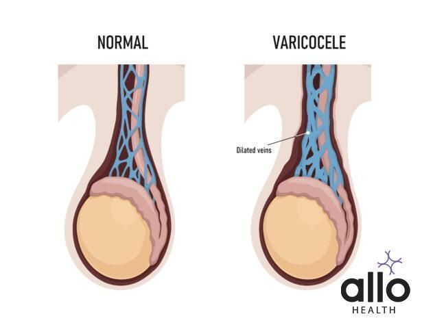 Varicocele in male reproductive system. Dilated veins. Can varicocele cause ed Varicocele Surgery And Erection Problems Varicocele Surgery And Erectile Dysfunction